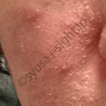 皮剥け期の頬の経過画像